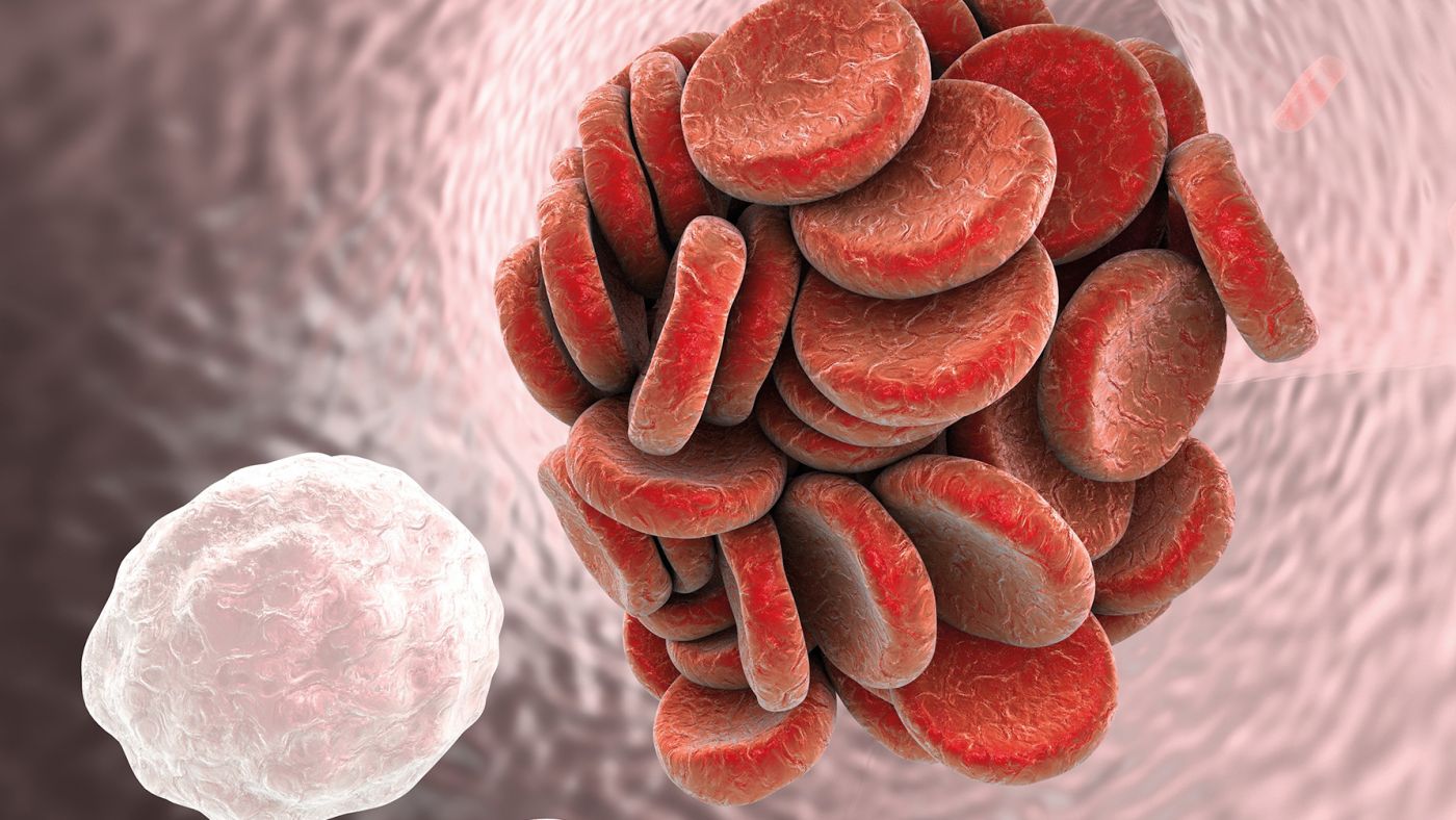 Trombosi VENOSA: cause e fattori scatenanti